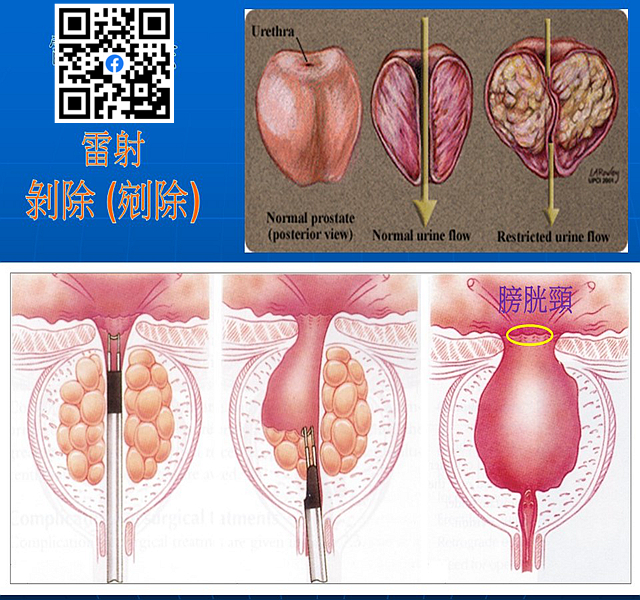 攝護腺肥大手術後遺症